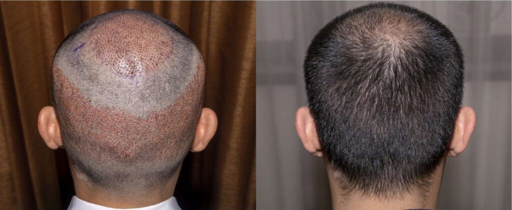 أفضل مراكز زراعة الشعر في اسطنبول