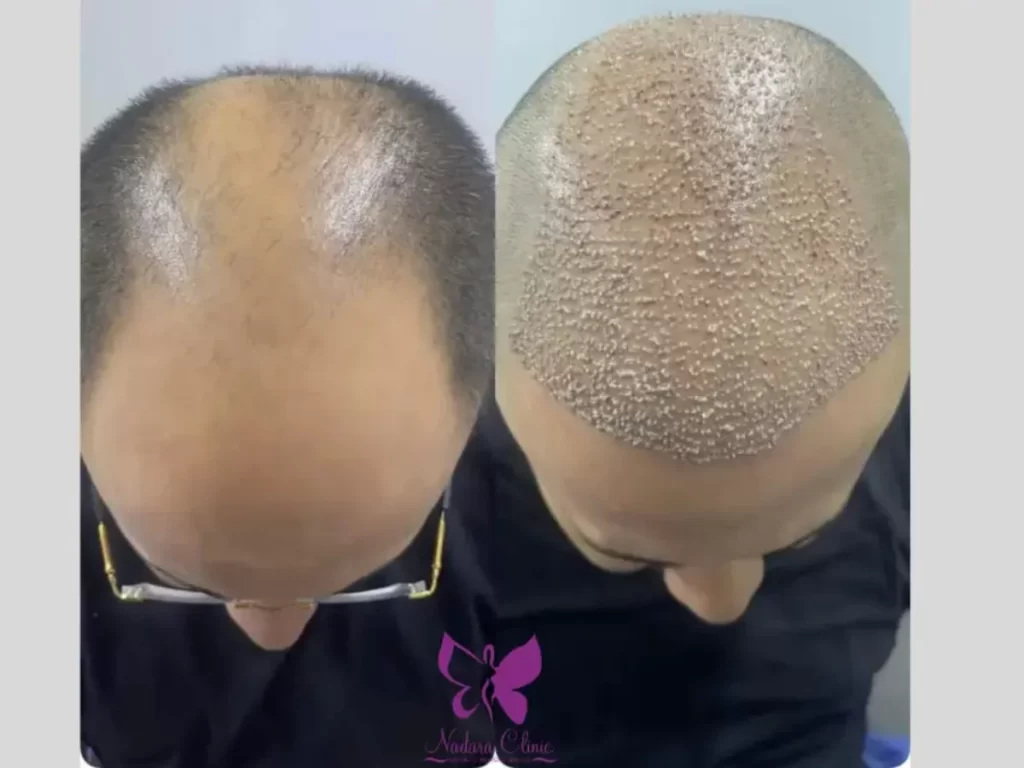 مراكز زراعة الشعر في أنطاليا